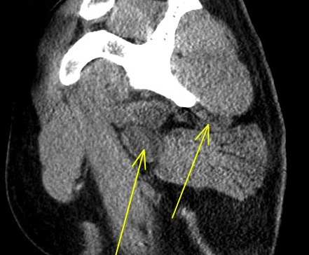 Figure 3 for case Axillary cyst and denervation